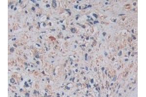 Detection of ADAM17 in Human Prostate cancer Tissue using Monoclonal Antibody to A Disintegrin And Metalloprotease 17 (ADAM17) (ADAM17 抗体  (AA 226-473))
