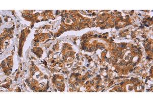 Immunohistochemistry of paraffin-embedded Human breast cancer tissue using CALCA Polyclonal Antibody at dilution 1:40 (CGRP 抗体)