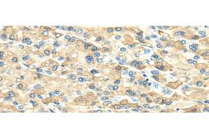 Immunohistochemistry of paraffin-embedded Human liver cancer using INHBB Polyclonal Antibody at dilution of 1/40 (INHBB 抗体)