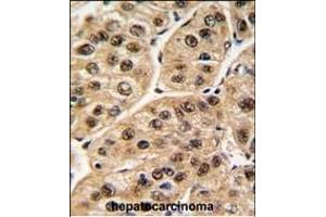 Formalin-fixed and paraffin-embedded human hepatocarcinoma tissue reacted with POLR1C antibody (C-term) (ABIN389351 and ABIN2839457) , which was peroxidase-conjugated to the secondary antibody, followed by DAB staining. (POLR1C 抗体  (C-Term))