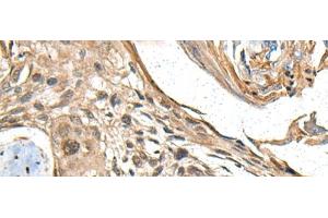 Immunohistochemistry of paraffin-embedded Human esophagus cancer tissue using MAPK4 Polyclonal Antibody at dilution of 1:35(x200) (MAPK4 抗体)