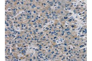 The image on the left is immunohistochemistry of paraffin-embedded Human liver cancer tissue using ABIN7131311(TBX18 Antibody) at dilution 1/20, on the right is treated with fusion protein.