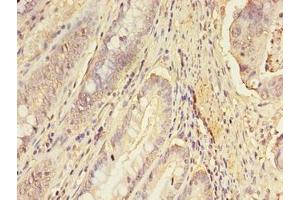 Immunohistochemistry of paraffin-embedded human colon cancer using ABIN7151689 at dilution of 1:100 (ERGIC1 抗体  (AA 48-254))