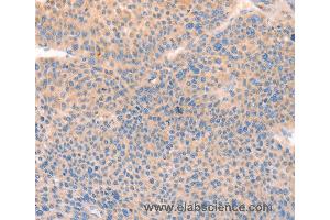 Immunohistochemistry of Human thyroid cancer using CD109 Polyclonal Antibody at dilution of 1:30 (CD109 抗体)