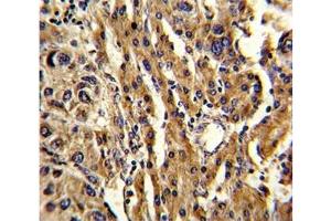 IHC analysis of FFPE human hepatocarcinoma stained with ABCG1 antibody