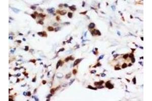 Immunohistochemical analysis of paraffin embedded cancer sections, staining in nucleus, DAB chromogenic reaction (BNIP3 抗体  (C-Term))