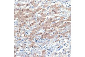 Immunohistochemistry of paraffin-embedded human liver cancer using [KO Validated] Smad4 Rabbit mAb (ABIN7270340) at dilution of 1:100 (40x lens). (SMAD4 抗体)