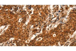 Immunohistochemistry of paraffin-embedded Human gastric cancer using CUEDC2 Polyclonal Antibody at dilution of 1:50 (CUEDC2 抗体)