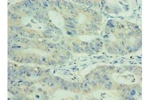Immunohistochemistry of paraffin-embedded human colon cancer using ABIN7159411 at dilution of 1:100 (MEP1A 抗体  (AA 440-700))