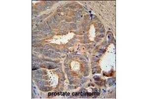 AZGP1 Antibody (N-term) (ABIN390565 and ABIN2840895) immunohistochemistry analysis in formalin fixed and paraffin embedded human prostate carcinoma followed by peroxidase conjugation of the secondary antibody and DAB staining. (AZGP1 抗体  (N-Term))