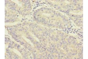 Immunohistochemistry of paraffin-embedded human endometrial cancer using ABIN7160214 at dilution of 1:100 (MORN5 抗体  (AA 1-161))