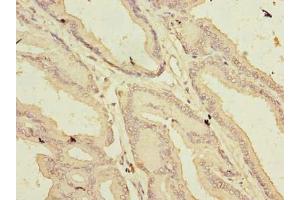 Immunohistochemistry of paraffin-embedded human prostate cancer using ABIN7144619 at dilution of 1:100 (ARMCX1 抗体  (AA 29-300))