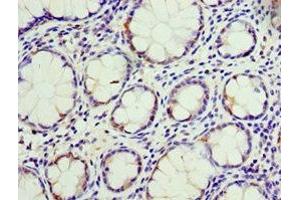 Immunohistochemistry of paraffin-embedded human colon cancer using ABIN7146792 at dilution of 1:100 (CEACAM3 抗体  (AA 1-135))