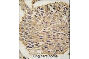 Formalin-fixed and paraffin-embedded human lung carcinoma tissue reacted with ALDOA antibody (C-term) (ABIN389192 and ABIN2839355) , which was peroxidase-conjugated to the secondary antibody, followed by DAB staining. (ALDOA 抗体  (C-Term))