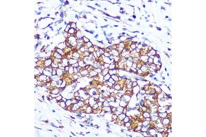 Immunohistochemistry of paraffin-embedded human esophageal cancer using Pannexin 1 Rabbit mAb (ABIN7269168) at dilution of 1:100 (40x lens). (PANX1 抗体)