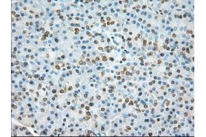 Immunohistochemical staining of paraffin-embedded Adenocarcinoma of colon tissue using anti-TACC3 mouse monoclonal antibody. (TACC3 抗体)