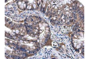 IHC-P Image NAT1 antibody [N1C1] detects NAT1 protein at cytoplasm in human colon carcinoma by immunohistochemical analysis. (NAT1 抗体)