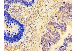 Immunohistochemistry of paraffin-embedded human ovarian cancer using ABIN7152824 at dilution of 1:100 (FGF8 抗体  (AA 23-143))