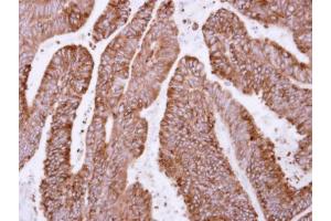IHC-P Image Immunohistochemical analysis of paraffin-embedded human colon carcinoma, using OSGEP, antibody at 1:500 dilution. (OSGEP 抗体)