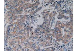 IHC-P analysis of Human Breast Cancer Tissue, with DAB staining. (NFkB 抗体  (AA 805-892))