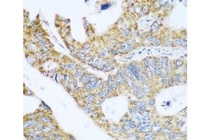 Immunohistochemistry of paraffin-embedded Human colon carcinoma using GLUD1 Polyclonal Antibody at dilution of 1:100 (40x lens). (GLUD1 抗体)