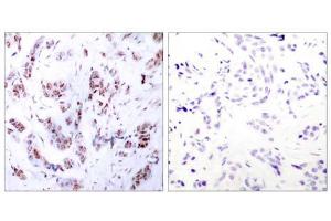 Immunohistochemical analysis of paraffin-embedded human breast carcinoma tissue using MEF2A (Ab-312) antibody (E021039). (MEF2A 抗体)