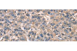 Immunohistochemistry of paraffin-embedded Human liver cancer tissue using ZFYVE19 Polyclonal Antibody at dilution of 1:60(x200) (ZFYVE19 抗体)