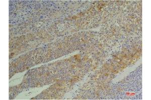 Immunohistochemistry (IHC) analysis of paraffin-embedded Human Heptacarcinoma using Cyclophilin B Mouse Monoclonal Antibody diluted at 1:200. (PPIB 抗体)