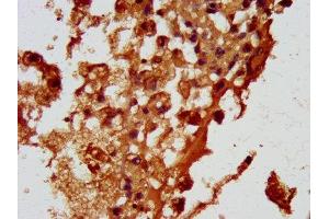 IHC image of ABIN7164700 diluted at 1:100 and staining in paraffin-embedded human melanoma performed on a Leica BondTM system. (HBEGF 抗体  (AA 63-148))