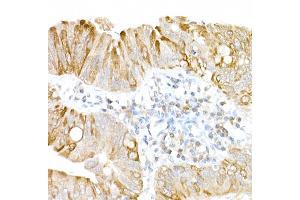 Immunohistochemistry of paraffin-embedded human colon carcinoma using USP18 Rabbit pAb (ABIN7271145) at dilution of 1:25 (40x lens). (USP18 抗体  (AA 200-300))