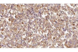 ABIN6278895 at 1/100 staining Human Melanoma tissue by IHC-P. (IL17F 抗体  (Internal Region))