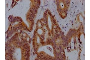 IHC image of ABIN7127869 diluted at 1:100 and staining in paraffin-embedded human colon cancer performed on a Leica BondTM system. (Recombinant Vitamin D Receptor 抗体)