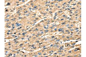 The image on the left is immunohistochemistry of paraffin-embedded Human liver cancer tissue using ABIN7131239(STX18 Antibody) at dilution 1/25, on the right is treated with fusion protein. (Syntaxin 18 抗体)
