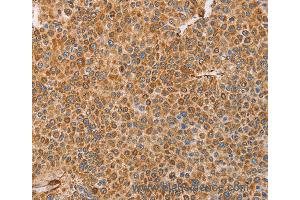 Immunohistochemistry of Human cervical cancer using BRS3 Polyclonal Antibody at dilution of 1:30 (BRS3 抗体)