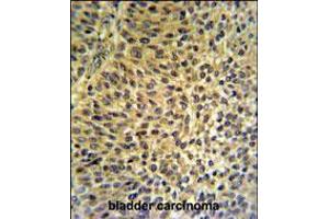 FUT6 Antibody IHC analysis in formalin fixed and paraffin embedded bladder carcinoma followed by peroxidase conjugation of the secondary antibody and DAB staining. (FUT6 抗体  (AA 102-130))