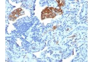 IHC testing of FFPE human lung carcinoma with DC-SIGN antibody (clone C209/1781). (DC-SIGN/CD209 抗体)
