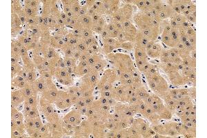 ABIN6256932 and ABIN6275042 at 1/100 staining human liver cancer by IHC-P. (Coxsackie Adenovirus Receptor 抗体  (N-Term))