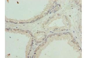 Immunohistochemistry of paraffin-embedded human prostate cancer using ABIN7164554 at dilution of 1:100 (SLC31A2 抗体  (AA 44-93))