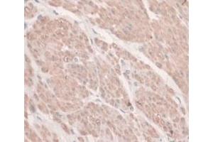 DAB staining on IHC-P; Samples: Human Prostate Gland Cancer Tissue. (HFE2 抗体  (AA 234-416))