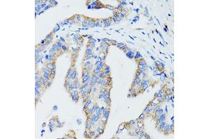 Immunohistochemistry of paraffin-embedded human gastric cancer using USO1 antibody. (USO1 抗体)