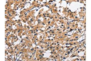 The image on the left is immunohistochemistry of paraffin-embedded Human thyroid cancer tissue using ABIN7128963(CLEC2D Antibody) at dilution 1/70, on the right is treated with fusion protein. (CLEC2D 抗体)