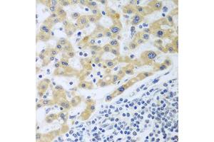 Immunohistochemistry of paraffin-embedded human liver cancer using SHBG antibody (ABIN6129327, ABIN6147736, ABIN6147737 and ABIN6223329) at dilution of 1:100 (40x lens). (SHBG 抗体  (AA 30-170))