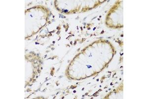 Immunohistochemistry of paraffin-embedded human gastric using UBE3A antibody (ABIN5975332) at dilution of 1/200 (40x lens). (ube3a 抗体)
