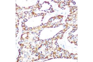 Immunohistochemistry of paraffin-embedded human lung cancer using γ-Catenin Rabbit mAb (ABIN1683043, ABIN3018625, ABIN3018626 and ABIN7101634) at dilution of 1:100 (40x lens).