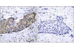 Immunohistochemistry analysis of paraffin-embedded human breast carcinoma tissue, using VEGFR2 (Ab-1214) Antibody. (VEGFR2/CD309 抗体  (AA 1180-1229))