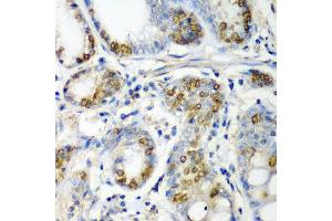 Immunohistochemistry of paraffin-embedded human colon carcinoma using CRYAA antibody at dilution of 1:200 (40x lens). (CRYAA 抗体)