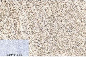 Immunohistochemical analysis of paraffin-embedded human uterus cancer tissue. (TUBB1 抗体)