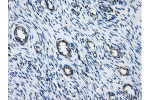 Immunohistochemical staining of paraffin-embedded Adenocarcinoma of breast tissue using anti-ACO2 mouse monoclonal antibody. (ACO2 抗体)