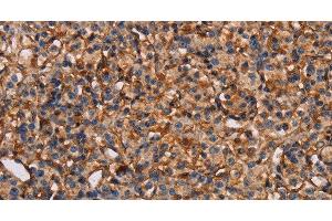 Immunohistochemistry of paraffin-embedded Human prostate cancer tissue using PLXNA1 Polyclonal Antibody at dilution 1:30 (Plexin A1 抗体)