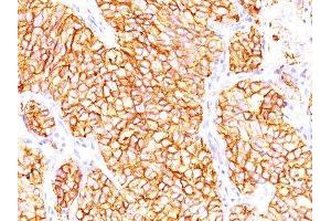 Image no. 1 for anti-Proximal-Nephrogenic Antigen / Renal Cell Carcinoma (RCC) antibody (ABIN6153756) (Proximal-Nephrogenic Antigen / Renal Cell Carcinoma (RCC) 抗体)